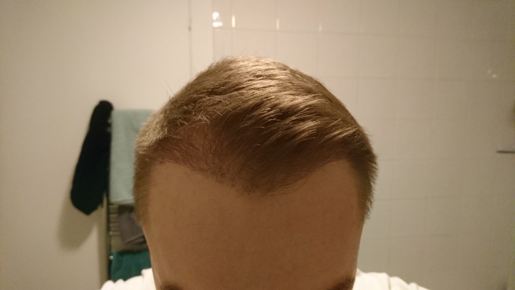 FUE Post-Op Pictures – 4 Months – Hair Transplant Story