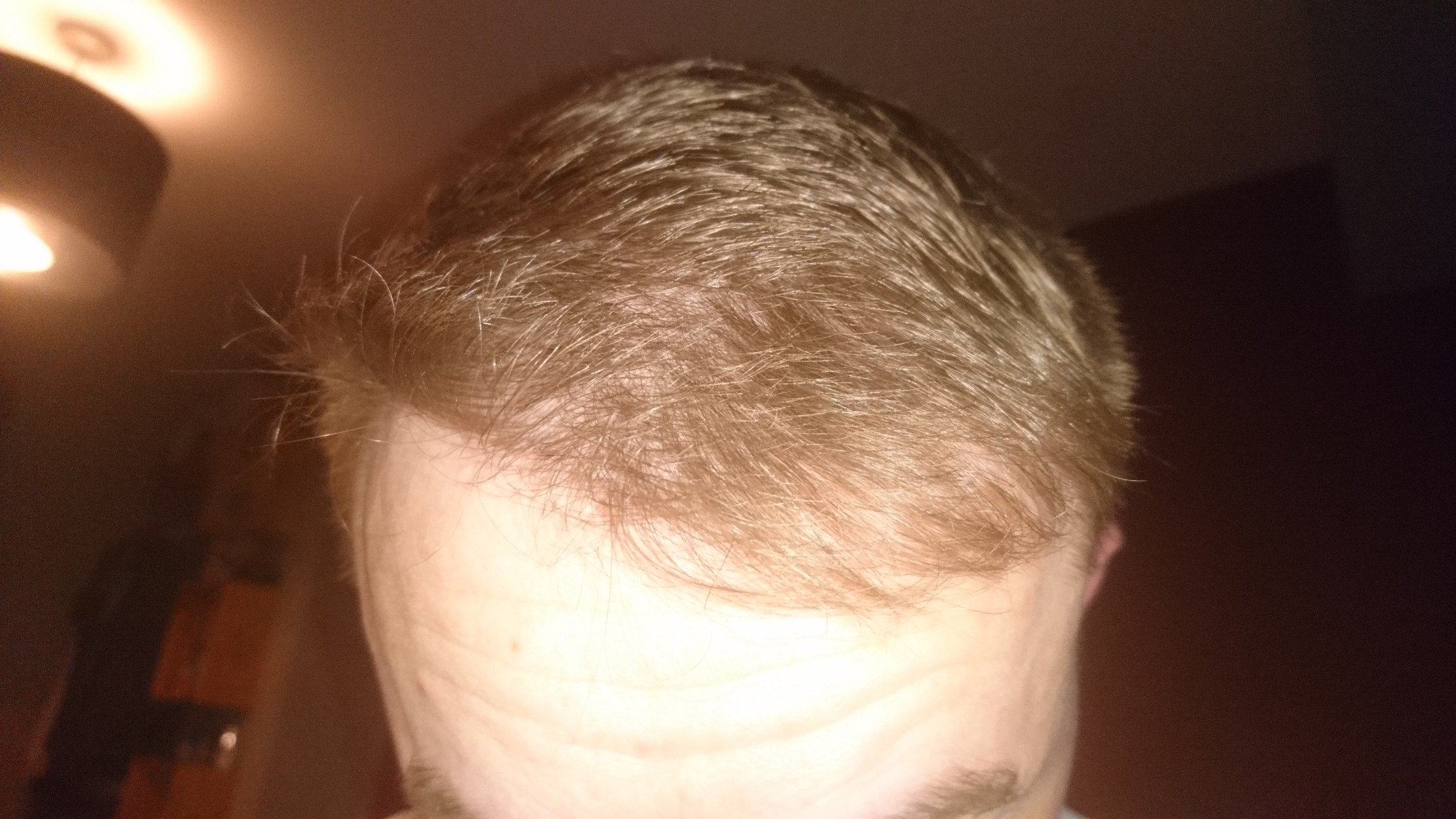 FUE Post-Op Pictures – 9 Months – Hair Transplant Story