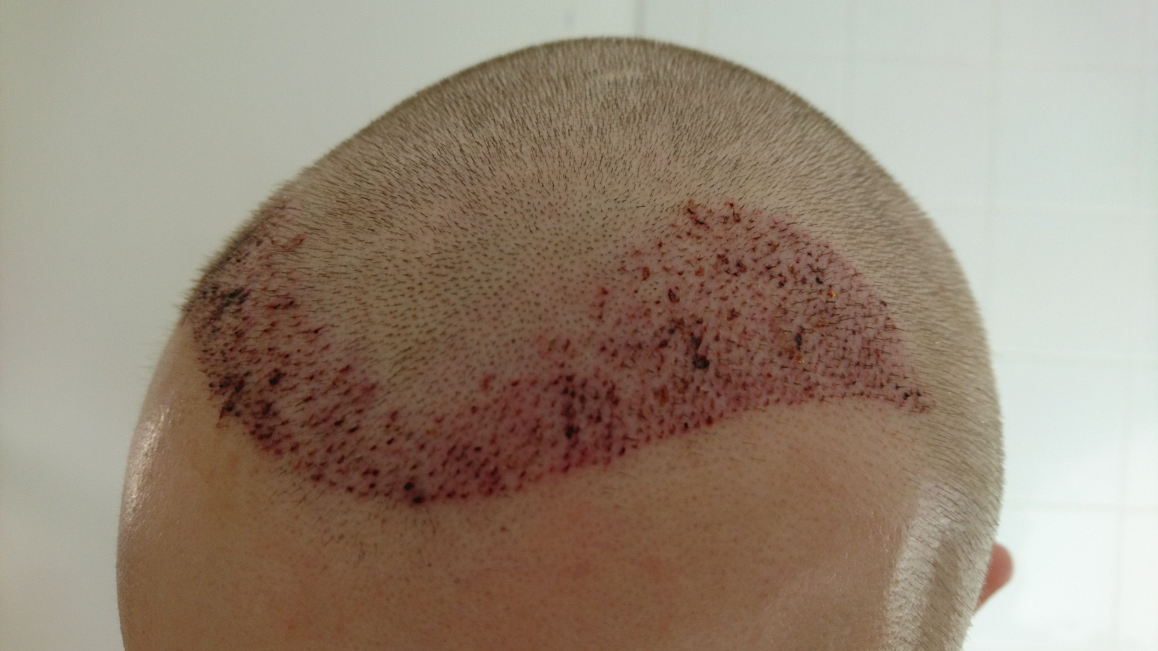 FUE Post-Op Pictures – Day 2 – Hair Transplant Story