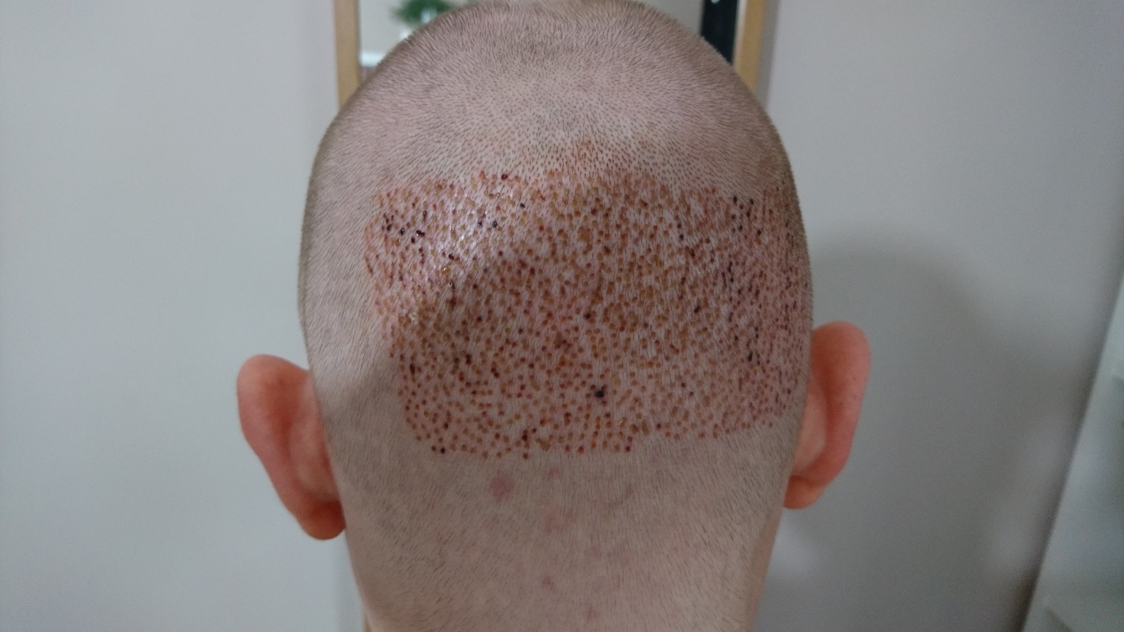 FUE Post-Op Pictures – Day 3 – Hair Transplant Story