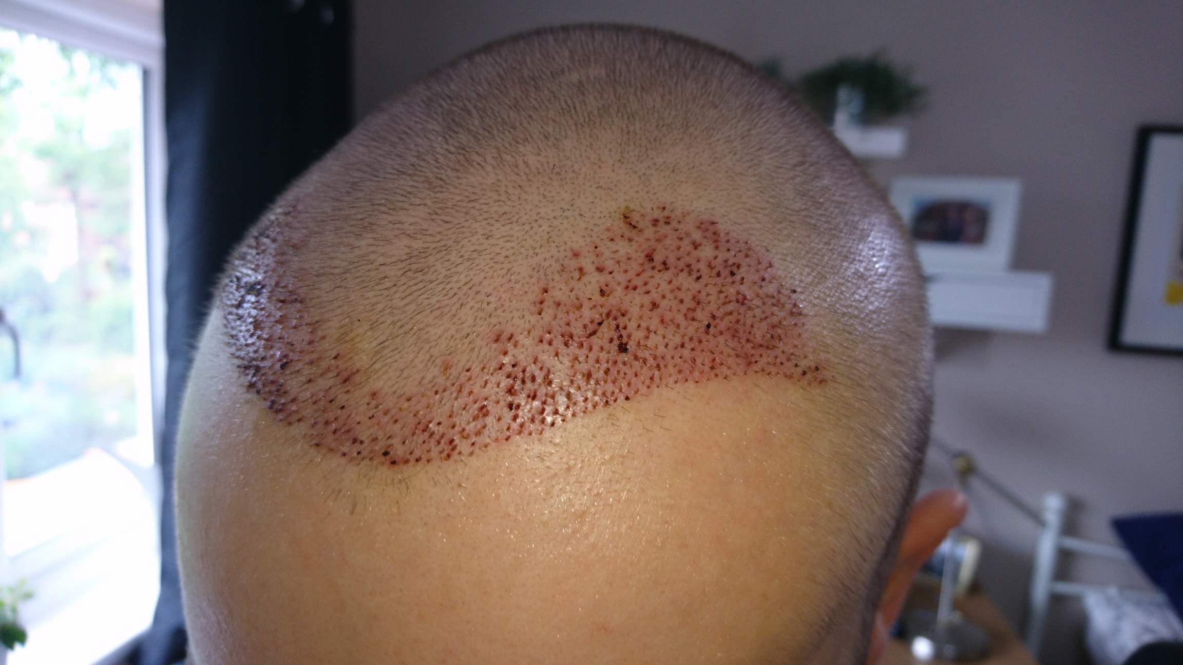 FUE Post-Op Pictures – Day 4 – Hair Transplant Story