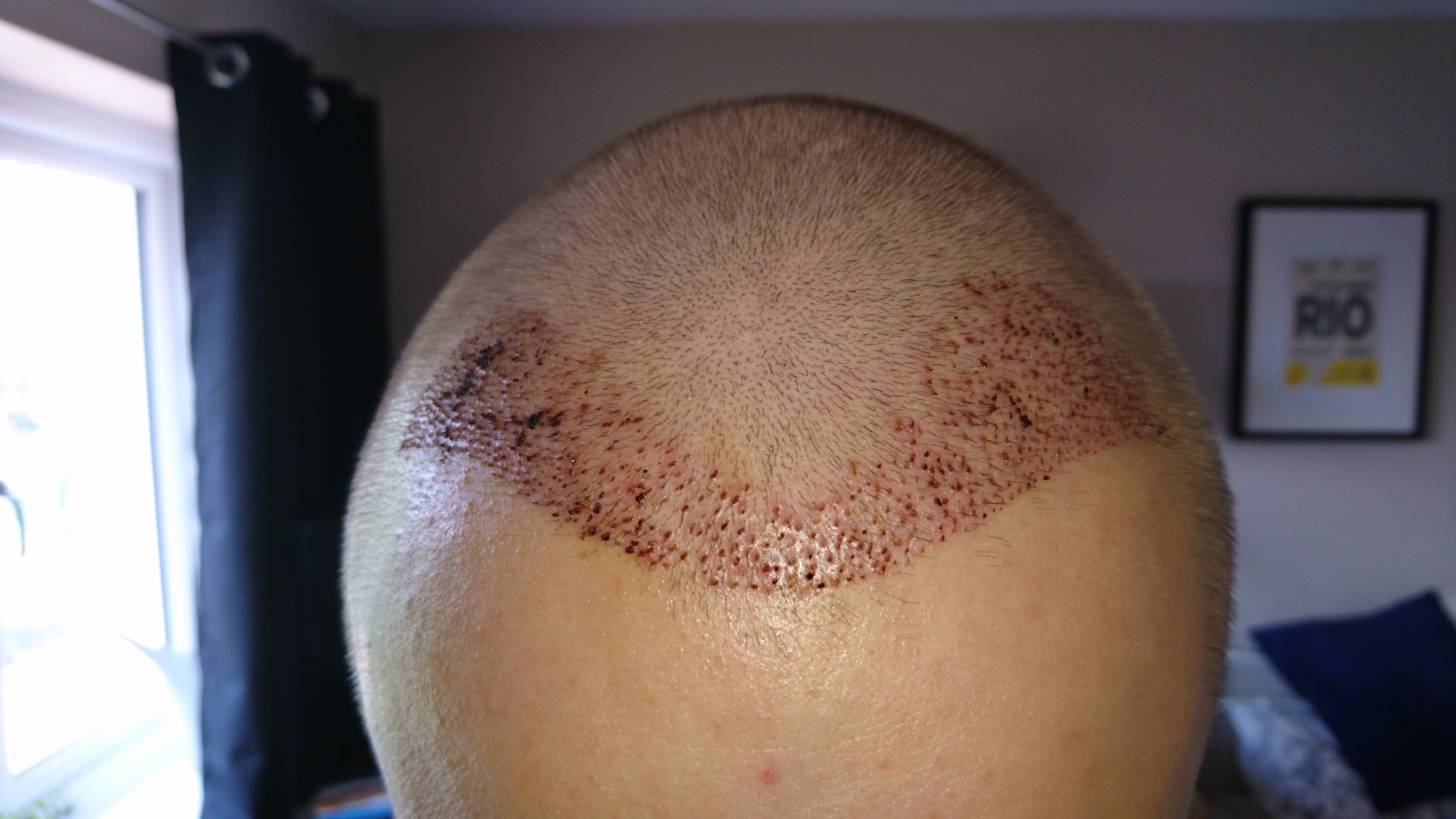 FUE Post-Op Pictures – Day 7 – Hair Transplant Story