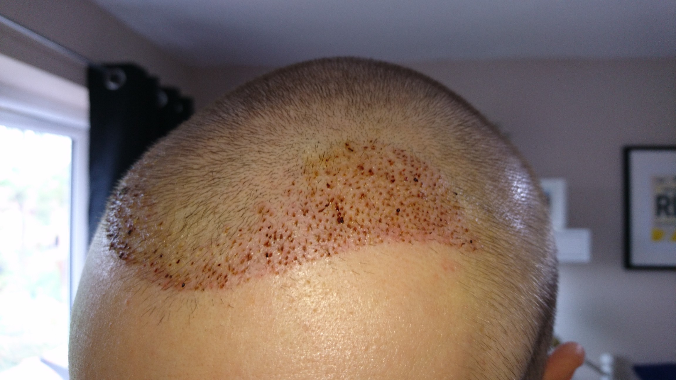 FUE Post-Op Pictures – Day 10 – Hair Transplant Story