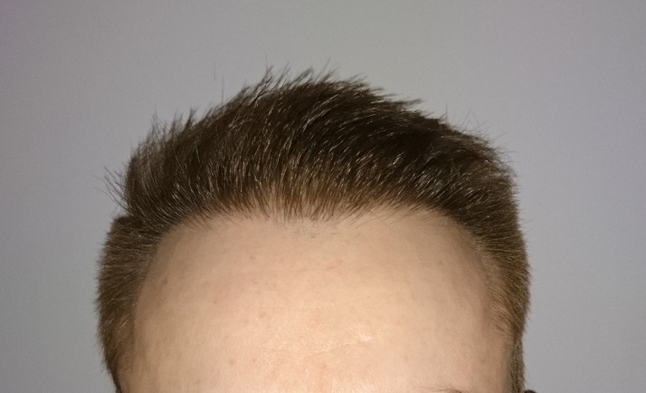 FUE Post-Op Pictures – 6 Months – Hair Transplant Story