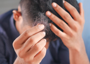 go bald after a hair transplant