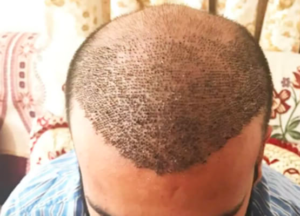 hair transpant muslim