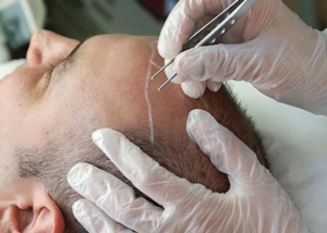 At What Age Can You Get A Hair Transplant