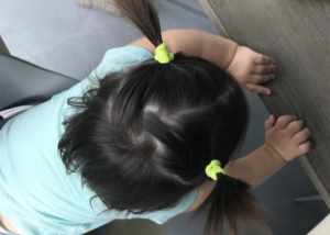 Can A Hair Transplant Get Rid Of A Cowlick?