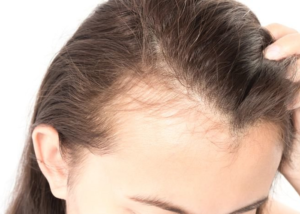 Can Diabetes Hair Loss Be Reversed