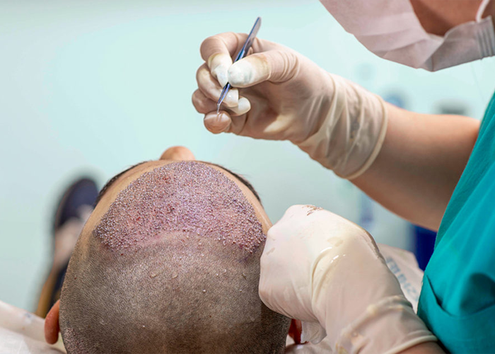Can Hair Transplant Cause Cancer