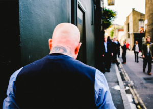 Can You Get A Hair Transplant If You Are Completely Bald