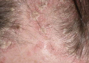 Can You Get A Hair Transplant With Psoriasis