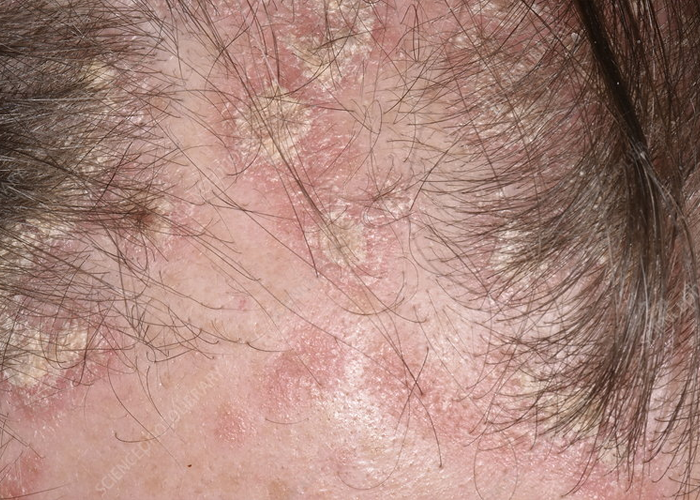 Can You Get A Hair Transplant With Psoriasis