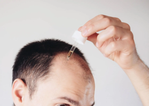 When Can I Use Minoxidil After A Hair Transplant